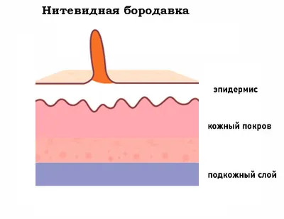 Нитевидные бородавки (акрохорды): лечение в МЦ Лазерсвiт Одесса