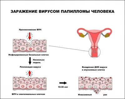 Папиллома: как передается вирус ВПЧ, насколько он опасен и можно ли  заразиться в общественном месте