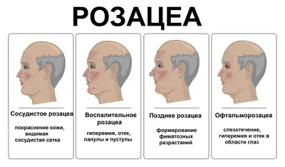 Лечение розацеа на лице в Астане, аппаратное лечение розацеа