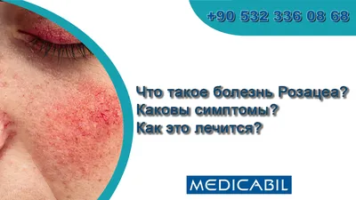 Розацеа — симптомы, причины, диагностика и способы лечения заболевания |  Клиника Биляка