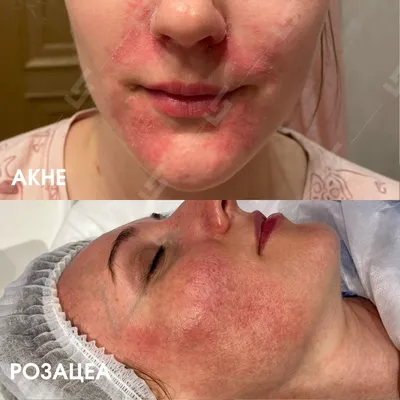 DERMAQUEST » Розацеа: как отличить от других кожных болезней| Статьи |  Отзывы | Купить