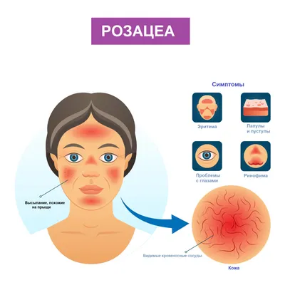 Розацеа лица (розовые угри) - причины, симптомы, диагностика, лечение