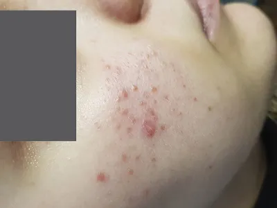 Лечение розацеа на лице в Астане, аппаратное лечение розацеа