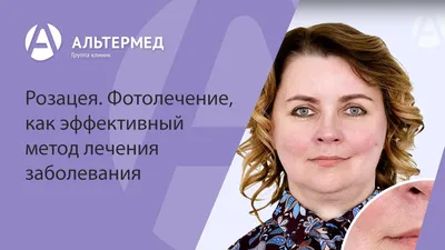 Лечение розацеа и купероза в Киеве | Цена в Brenner Clinic
