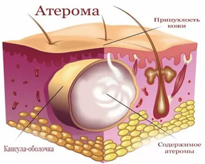 Марсупиализация кисты бартолиновой железы: цены в Москве | АльтраВита