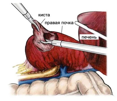 Парауретральная киста - причины и признаки парауретральной кисты