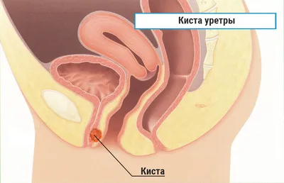 А точно ли цистит? Причиной болезненного учащенного мочеиспускания и даже  плохих анализов мочи может быть парауретральная киста. Это… | Instagram