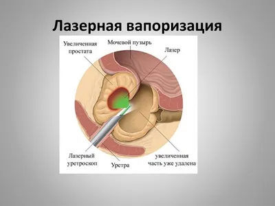 Лапароскопическое / ретроперитонеоскопическое иссечение простых кист почек