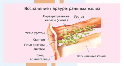 А точно ли цистит? Причиной болезненного учащенного мочеиспускания и даже  плохих анализов мочи может быть парауретральная киста. Это… | Instagram