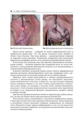 Киста наружного отверстия уретры. Парауретральная киста. Дивертикул уретры.  - YouTube