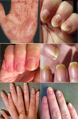 Паразитарные заболевания кожи фото фотографии