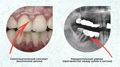 Кюретаж пародонтальных карманов - Стоматология \"Дантист\" в Воронеже