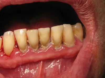 Стоматология \"Династия\" - Лечение десневого кармана. Десневые карманы  представляет собой углубление между десной и зубом, это углубление  представляет собой «динамическое место». Оно заполнено зубными отложениями,  грануляциями и иногда гноем Десневой ...