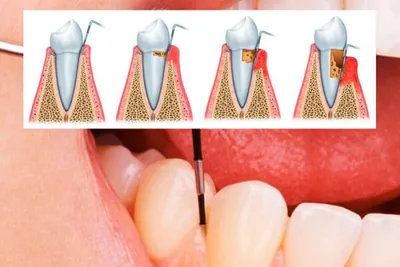 Кюретаж пародонтального кармана десен: открытый и закрытый в стоматологии в  Феодосии