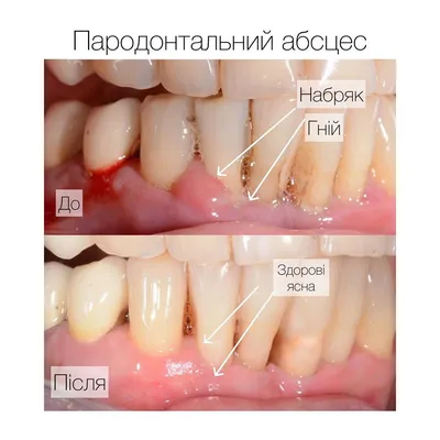 Как лечить десневой карман - Стоматология \"Алекс\" в Жуковском