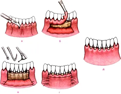 Кюретаж пародонтального кармана в Москве - что это, цена, особенности  процедуры