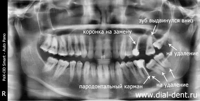 Что такое пародонтальные карманы и как лечится их воспаление? | СКАЙКЛИНИК