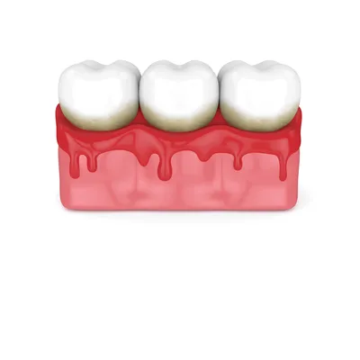 Виды и стоимость гингивэктомии в Москве | Клиника \"МАЙ\"