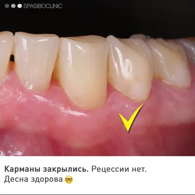 Кюретаж пародонтального кармана десен: открытый и закрытый в стоматологии в  Феодосии