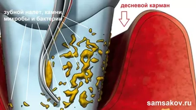 Как лечить десневой карман - Стоматология \"Алекс\" в Жуковском