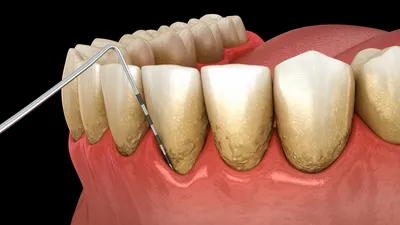 Пародонтальный карман | Стоматология Дентал-центр Липинский
