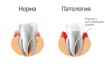 Как лечить десневые карманы наиболее эффективно - Альянс  бьюти-стоматологов, Москва
