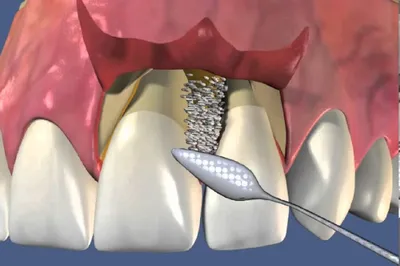Закрытый кюретаж пародонтальных карманов, цена ❘ ОртодонтКомплекс