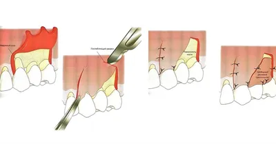 Пародонтальный карман - parodont.pro