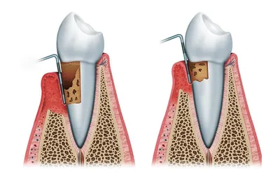 Кюретаж пародонтального кармана на Белорусской, цены на кюретаж пародонтального  кармана недорого в Москве | Центр дентальной имплантологии Доктора Севака