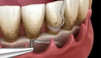 Кюретаж в стоматологии - открытый, закрытый кюретаж зубов и десен