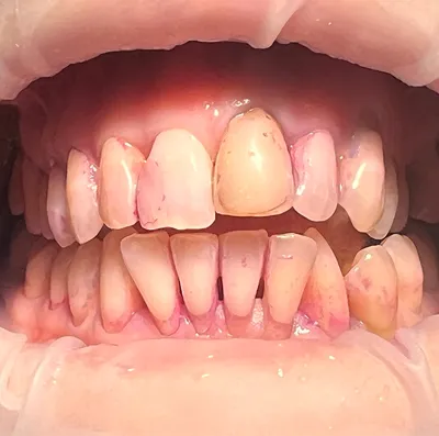 Что такое открытый и закрытый кюретаж десен и когда он применяется | Dental  Art
