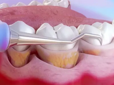 Карман в десне между зубами: 10 признаков того, что необходимо начинать  лечение