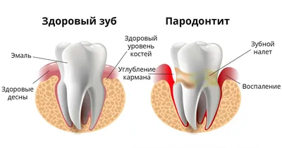 Пародонтит [классификация, симптомы и лекарства]