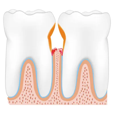Болезнь зубов: Пародонтит — Стоматология «Доктор НеболитЪ»