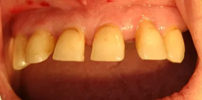 Ювенильный пародонтит зубов (десмодонтоз): причины, диагностика, лечение
