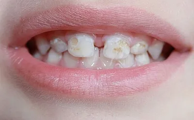 Патологическая стираемость зубов: лечение, фото | Dental Art
