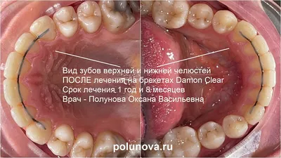 Аномалии развития детских зубов - симптомы и лечение – статьи детской  стоматологической клиники «Мартинка»