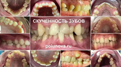 Коронки на зубах занизили прикус и разрушили другие зубы – клиника Smile  STD, Москва
