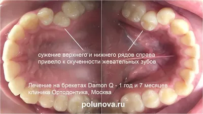 Полиодонтия или сверхкомплектные зубы: почему нужно удалять