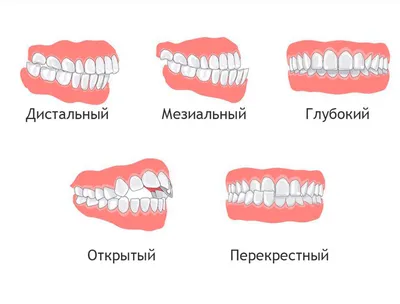 Болезни молочных зубов | Статьи стоматологии в Николаеве