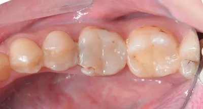 Коронки на зубах занизили прикус и разрушили другие зубы – клиника Smile  STD, Москва