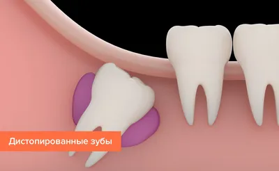 Болезни зубов у человека: Патологии прорезывания и формирования зубов —  Стоматология «Доктор НеболитЪ»
