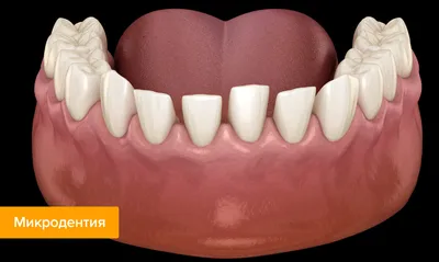 Коронки на зубах занизили прикус и разрушили другие зубы – клиника Smile  STD, Москва