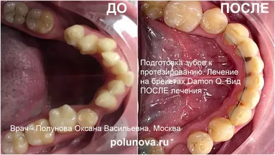 Как лечить скученность зубов в разном возрасте | Клиника Ортодонтика, Москва