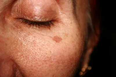 Пигментация кожи: что это, причины нарушения и способы лечения | РБК Стиль