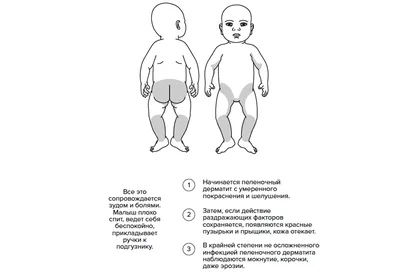 Что такое пеленочный дерматит: отрывок из книги Анны Левадной