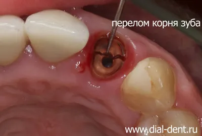 Перелом переднего зуба и одномоментная имплантация
