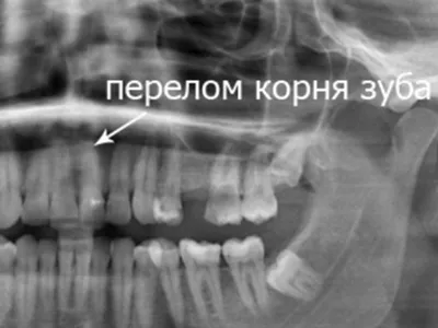 Удаление корня зуба Москва ЦАО по доступным ценам стоматология Внуки  Гиппократа