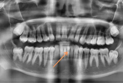 Одномоментная имплантация после перелома корня зуба :: NORD DENTAL — сеть  клиник семейной стоматологии на севере Петербурга