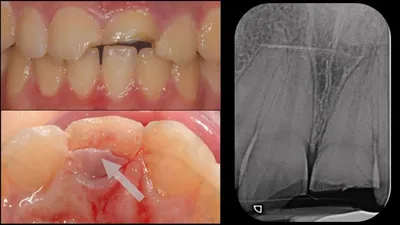 Перелом Коронки Зуба: Использование Отколовшейся Части